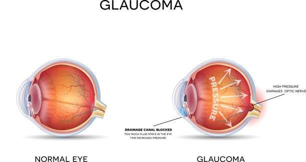 Understanding Glaucoma: Early Detection & Treatment Options
