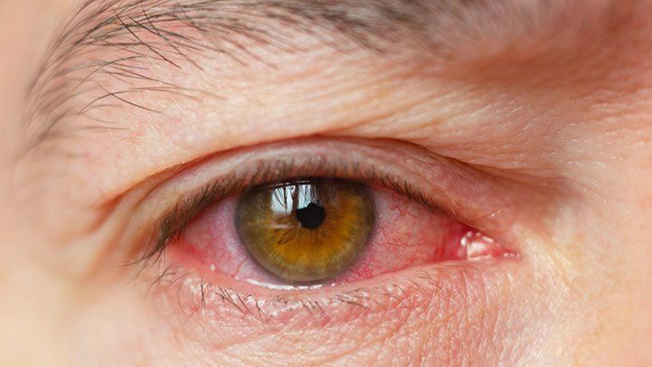 Dry Eyes: Causes, Symptoms & Effective Treatment Options
